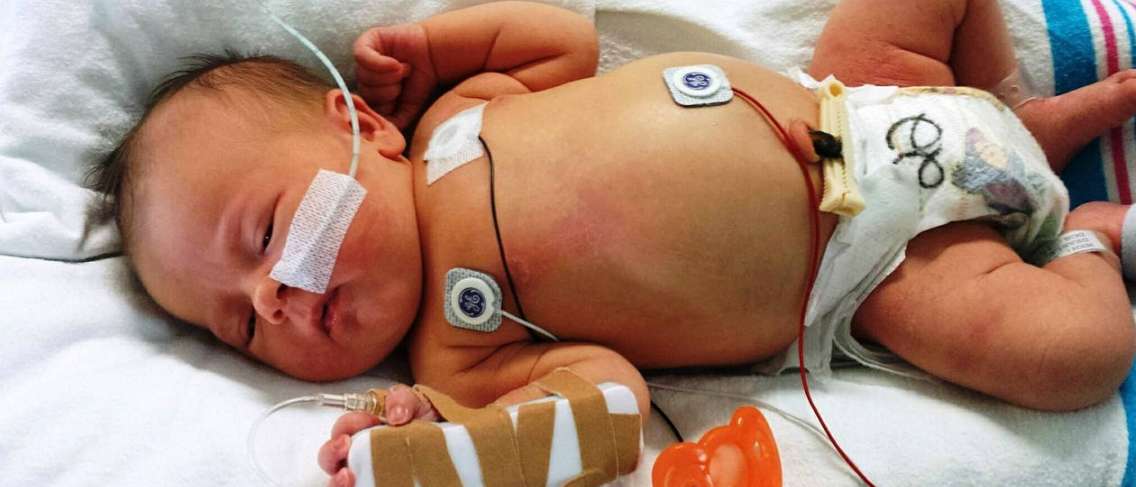 Warning!! Pakar Sebut Angka Penyakit Jantung Bawaan pada Bayi Tetap Tinggi